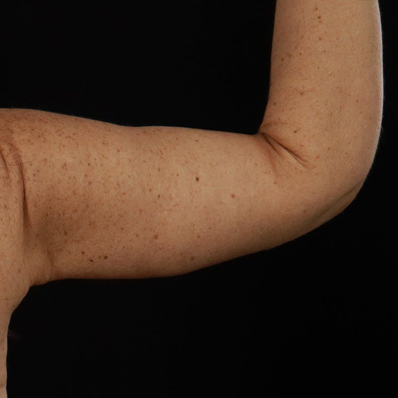 Arm Lift Before & After Gallery - Patient 323909 - Image 8