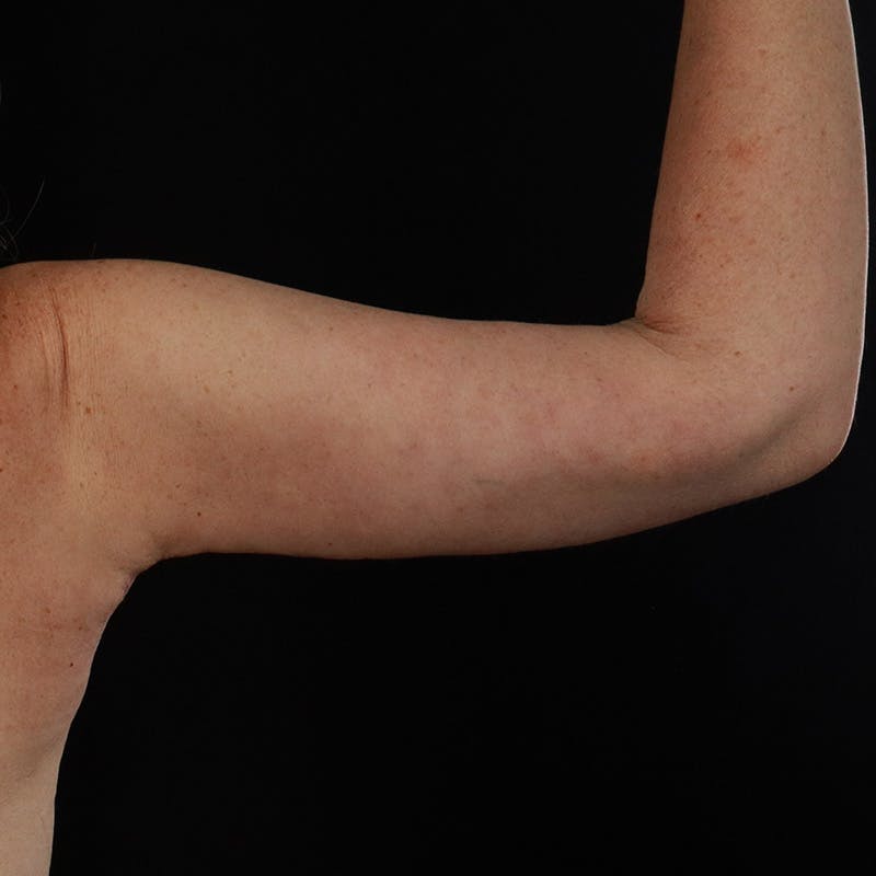 Arm Lift Before & After Gallery - Patient 169013 - Image 8