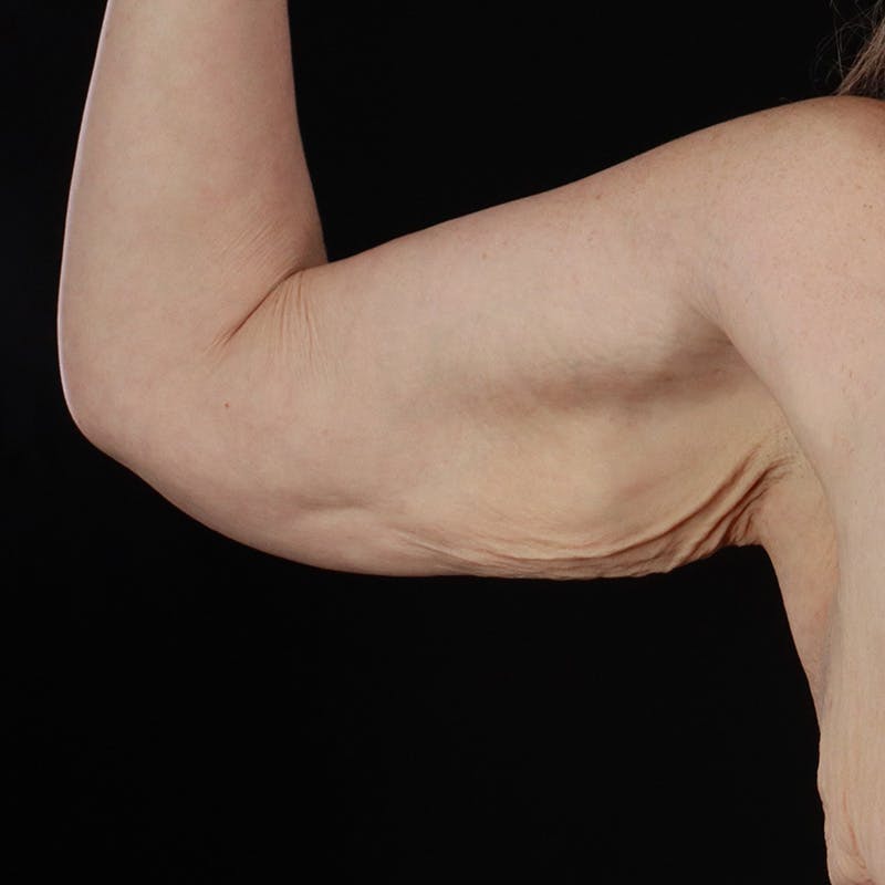 Arm Lift Before & After Gallery - Patient 169013 - Image 1