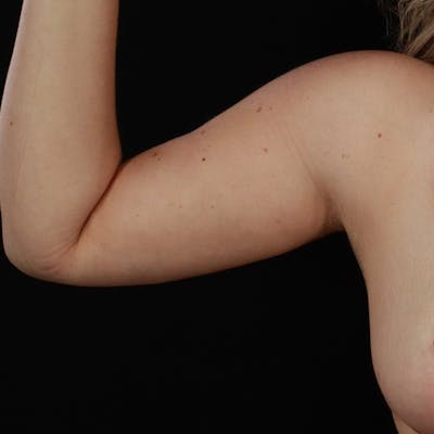 Arm Lift Before & After Gallery - Patient 405437 - Image 2