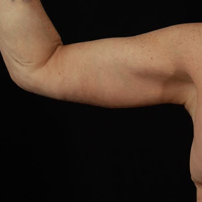 Arm Lift Before & After Gallery - Patient 323909 - Image 2