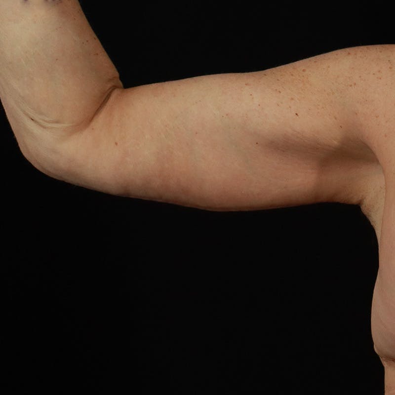 Arm Lift Before & After Gallery - Patient 323909 - Image 2