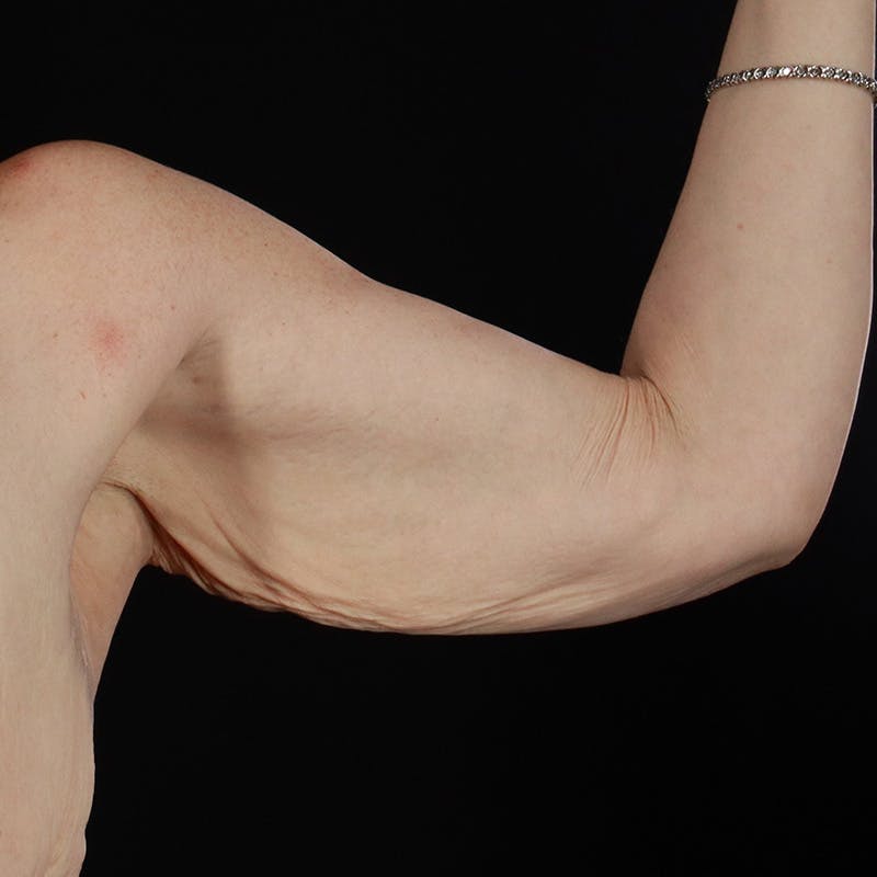 Arm Lift Before & After Gallery - Patient 169013 - Image 5