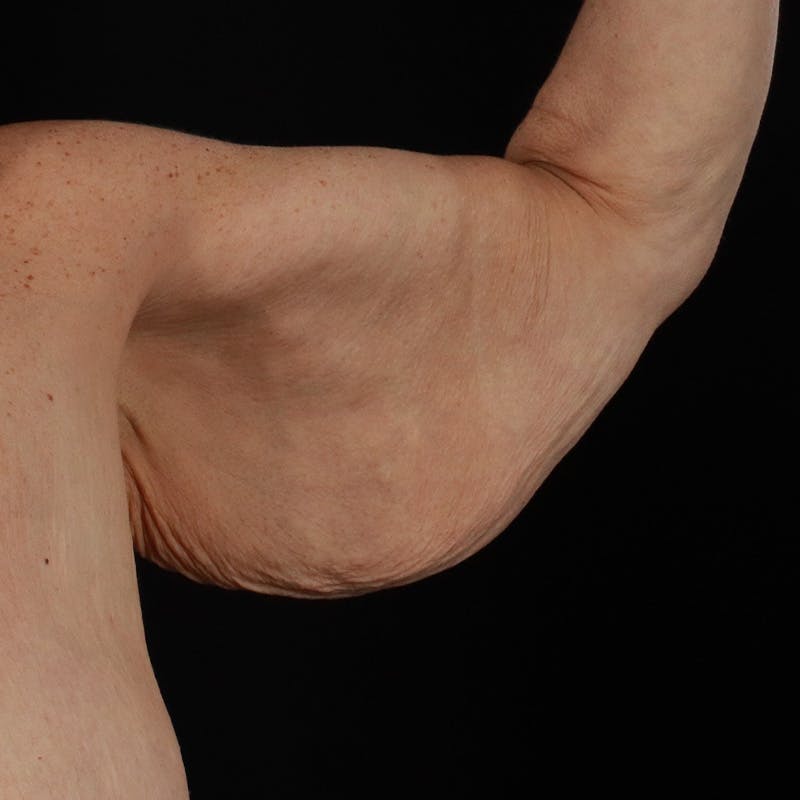 Arm Lift Before & After Gallery - Patient 323909 - Image 5
