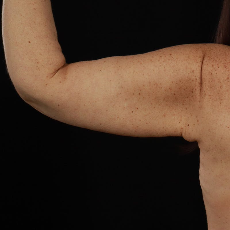 Arm Lift Before & After Gallery - Patient 323909 - Image 4