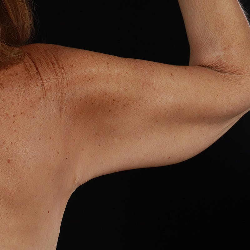 Arm Lift Before & After Gallery - Patient 114497 - Image 7
