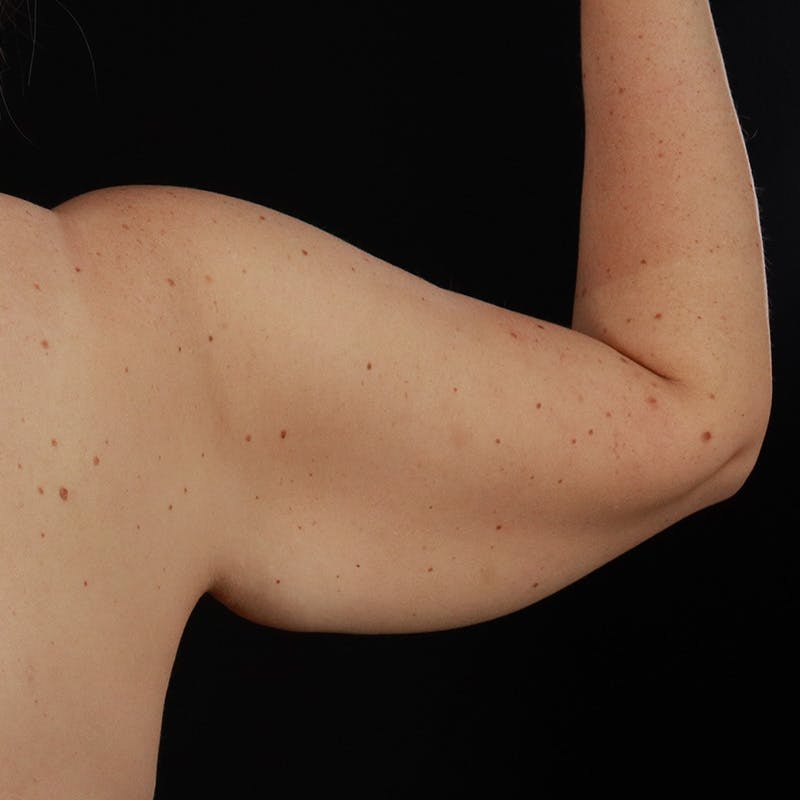 Arm Lift Before & After Gallery - Patient 405437 - Image 7