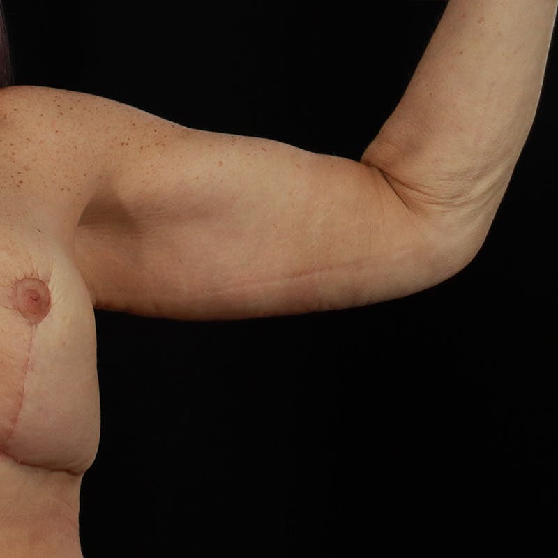 Arm Lift Before & After Gallery - Patient 323909 - Image 6