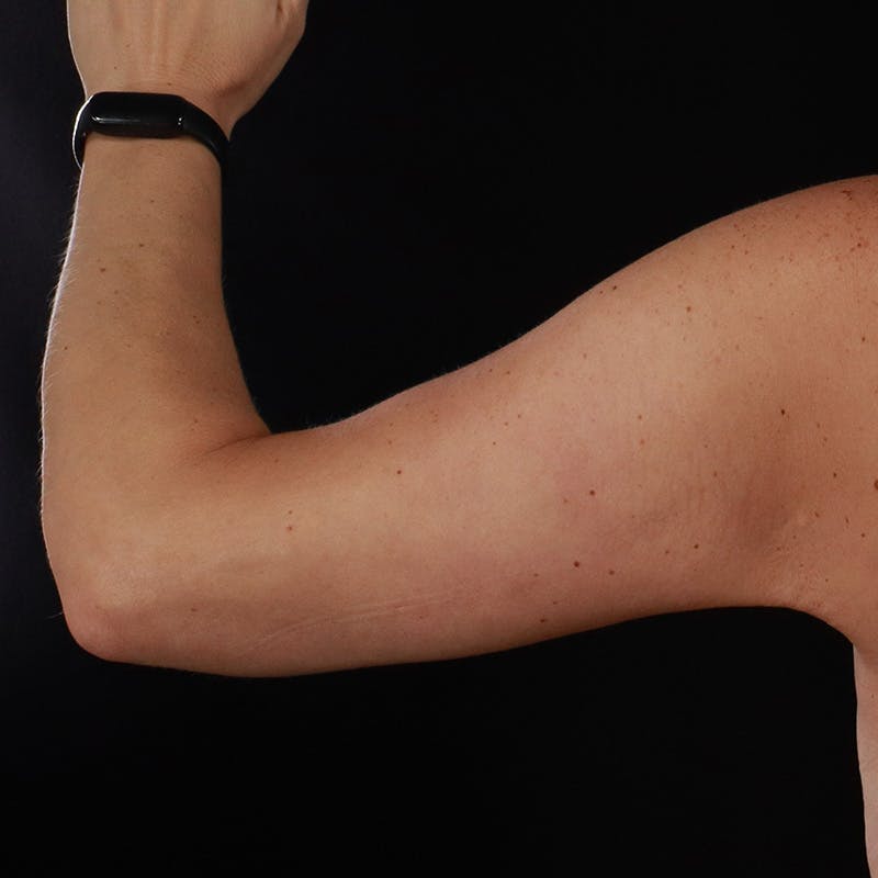 Arm Lift Before & After Gallery - Patient 169845 - Image 4