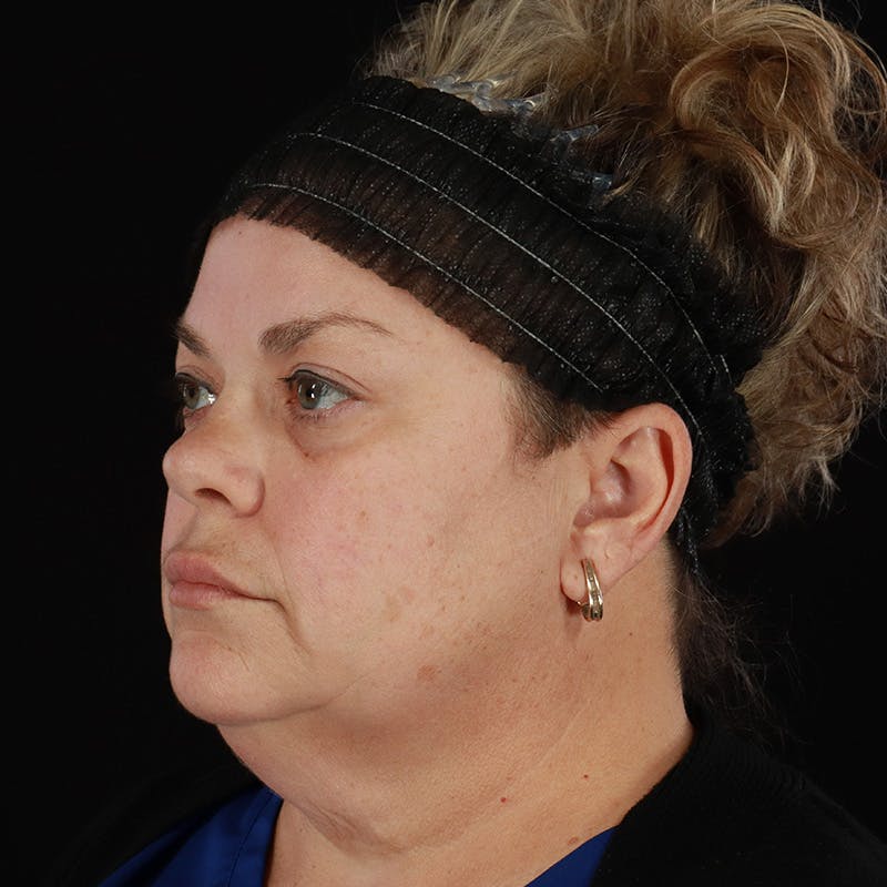 Neck Lift Before & After Gallery - Patient 407250 - Image 1