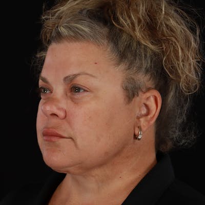 Neck Lift Before & After Gallery - Patient 407250 - Image 2