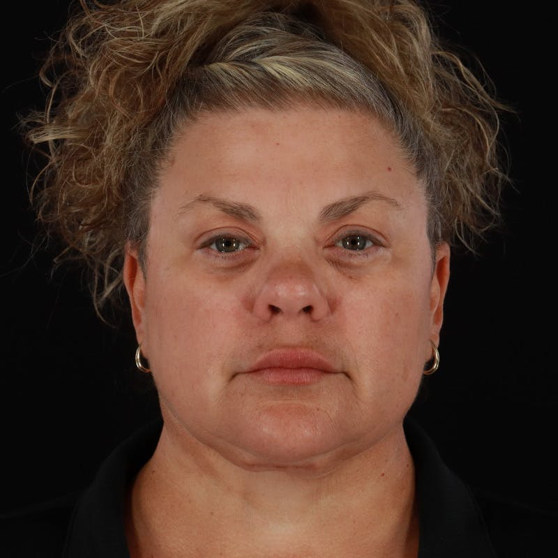 Neck Lift Before & After Gallery - Patient 407250 - Image 4