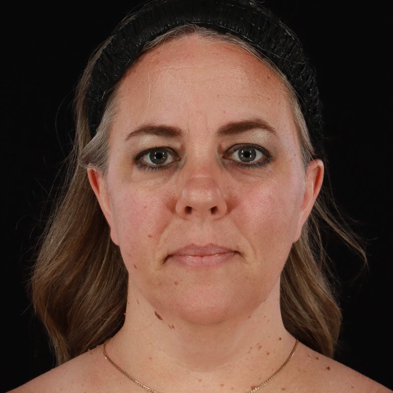 Neck Lift Before & After Gallery - Patient 385922 - Image 5