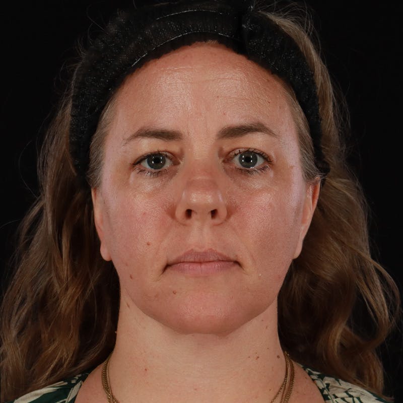 Neck Lift Before & After Gallery - Patient 385922 - Image 6
