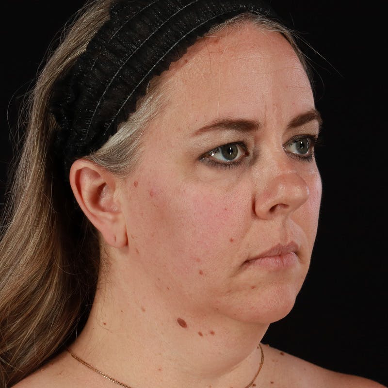 Neck Lift Before & After Gallery - Patient 385922 - Image 7