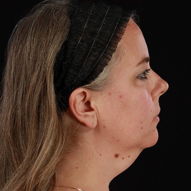 Neck Lift Before & After Gallery - Patient 385922 - Image 9