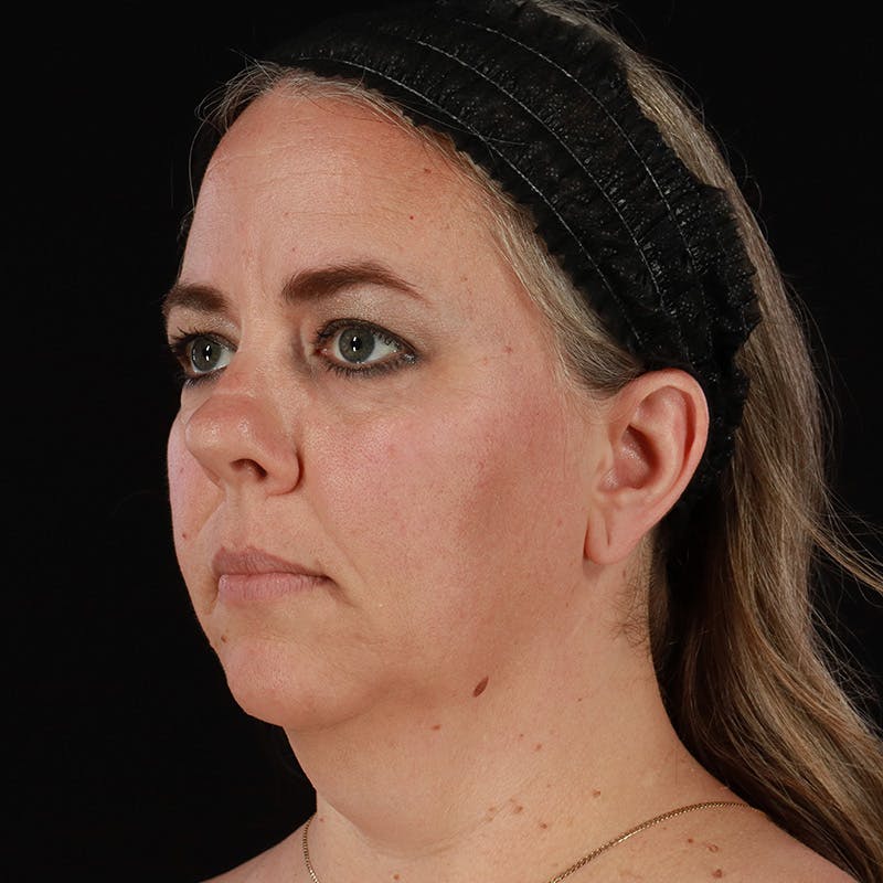 Neck Lift Before & After Gallery - Patient 385922 - Image 3
