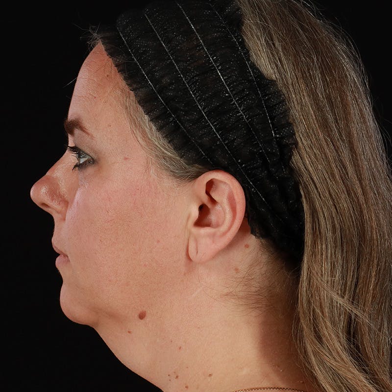 Neck Lift Before & After Gallery - Patient 385922 - Image 1