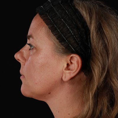 Neck Lift Before & After Gallery - Patient 385922 - Image 2