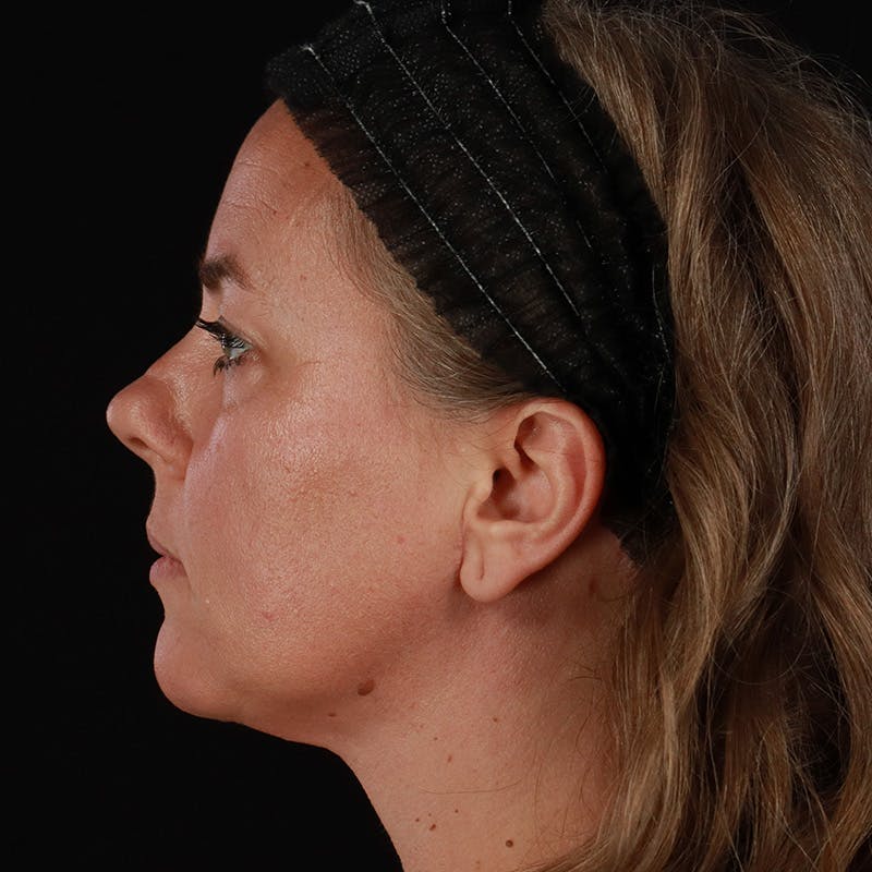 Neck Lift Before & After Gallery - Patient 385922 - Image 2