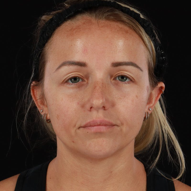 Neck Lift Before & After Gallery - Patient 718295 - Image 6