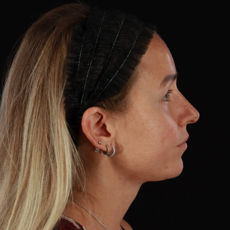 Neck Lift Before & After Gallery - Patient 718295 - Image 10