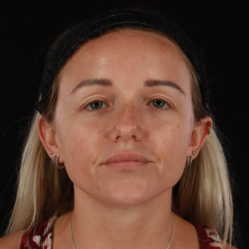 Neck Lift Before & After Gallery - Patient 718295 - Image 5