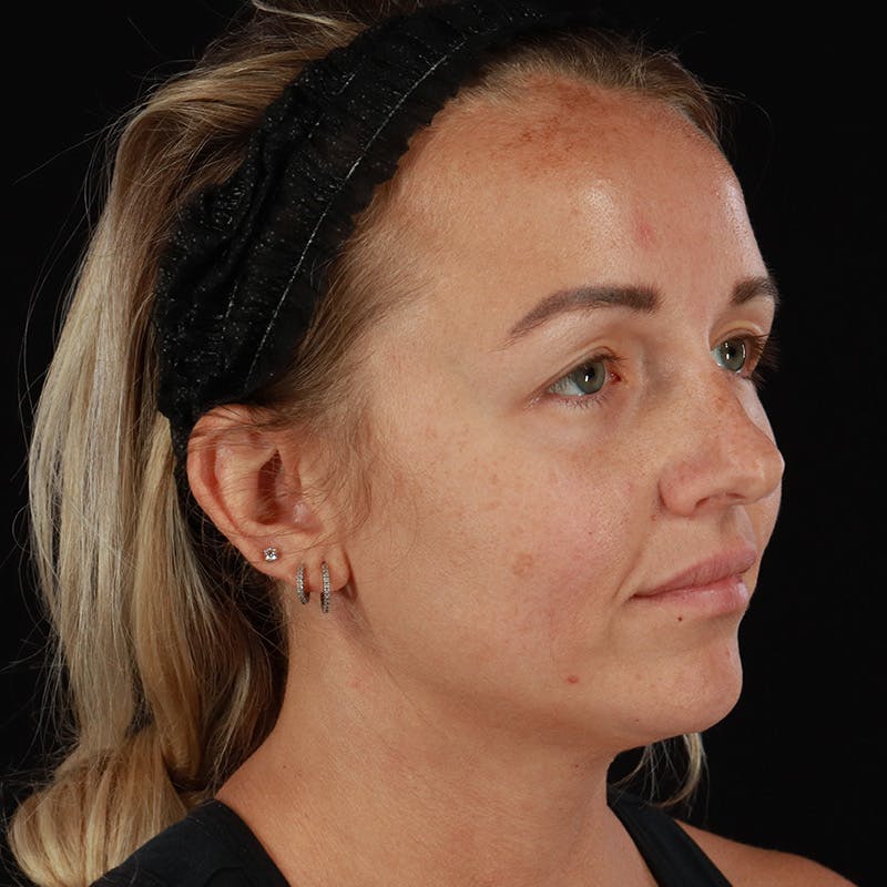 Neck Lift Before & After Gallery - Patient 718295 - Image 7