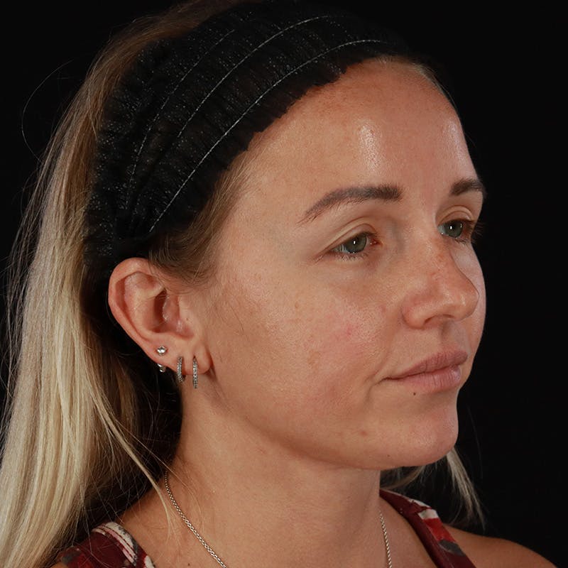 Neck Lift Before & After Gallery - Patient 718295 - Image 8