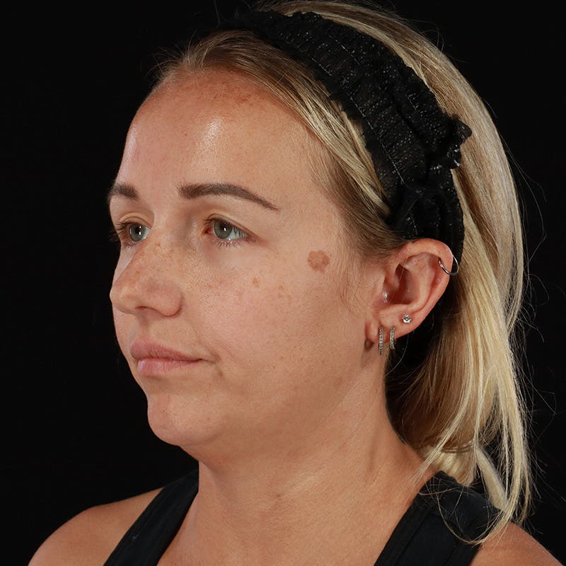 Neck Lift Before & After Gallery - Patient 718295 - Image 3
