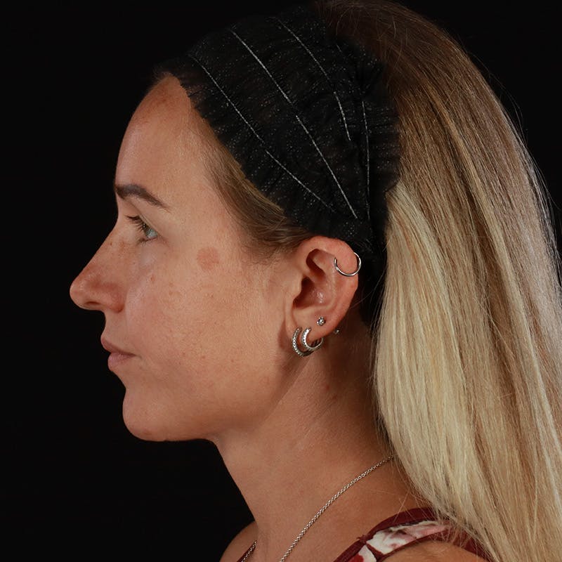 Neck Lift Before & After Gallery - Patient 718295 - Image 2