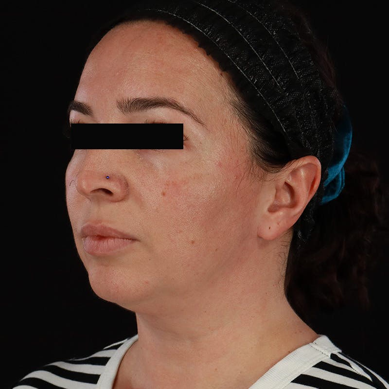 Neck Lift Before & After Gallery - Patient 413347 - Image 3