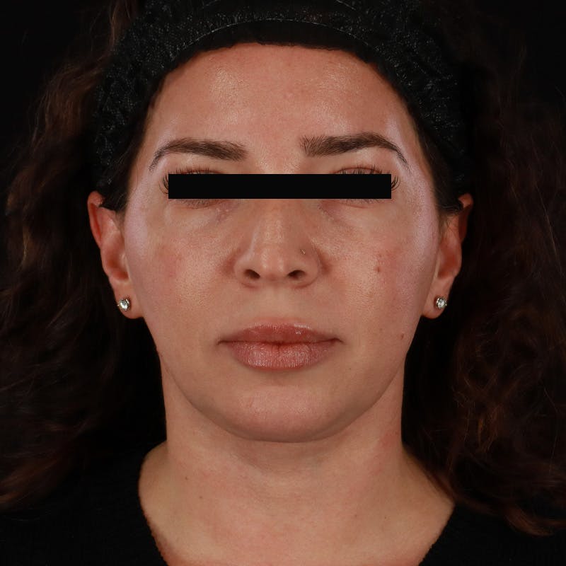 Neck Lift Before & After Gallery - Patient 413347 - Image 6