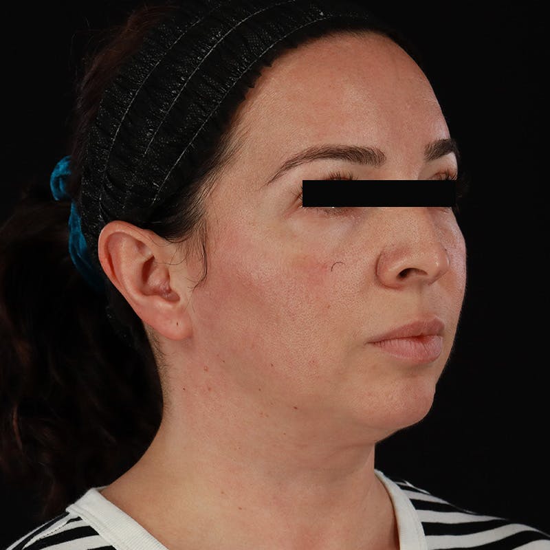 Neck Lift Before & After Gallery - Patient 413347 - Image 7