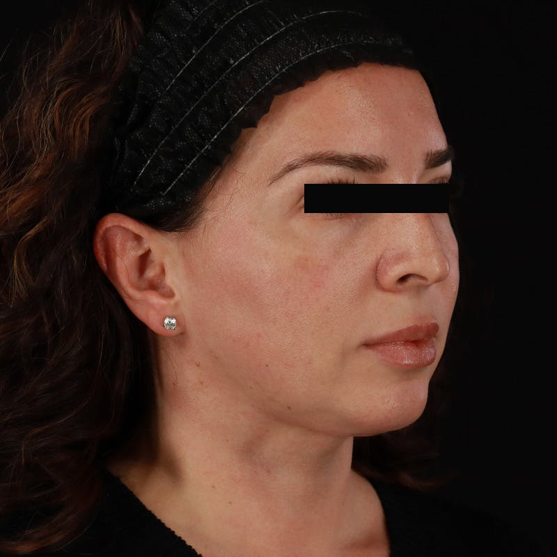 Neck Lift Before & After Gallery - Patient 413347 - Image 8