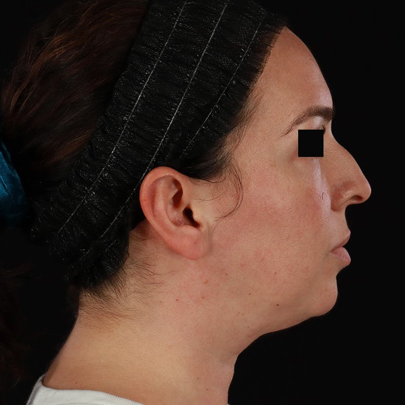 Neck Lift Before & After Gallery - Patient 413347 - Image 9