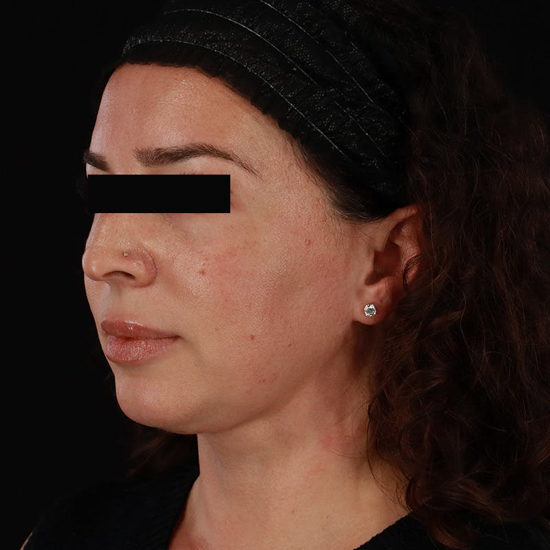 Neck Lift Before & After Gallery - Patient 413347 - Image 4