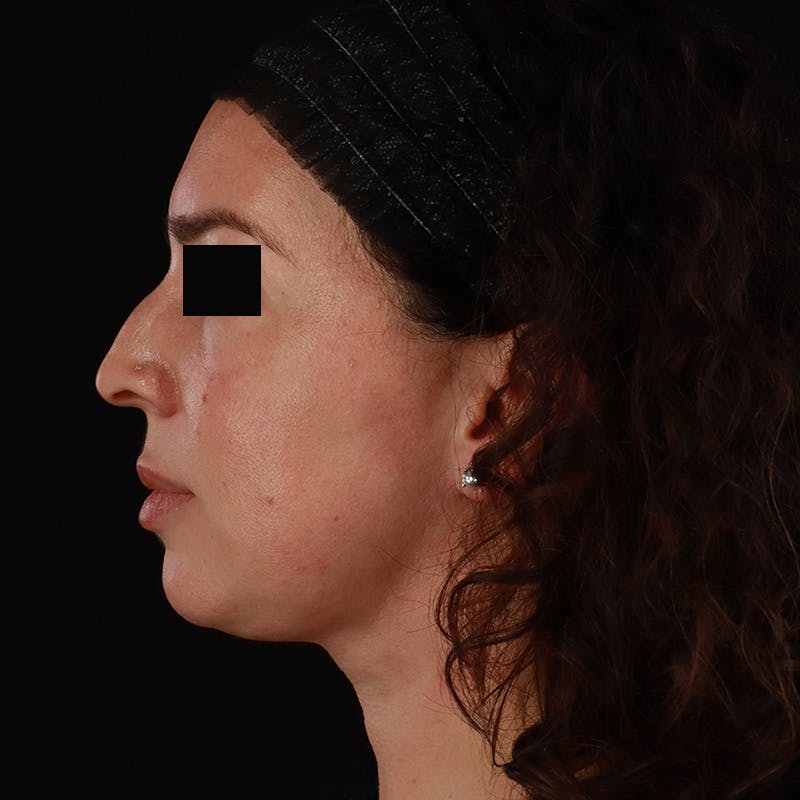 Neck Lift Before & After Gallery - Patient 413347 - Image 2