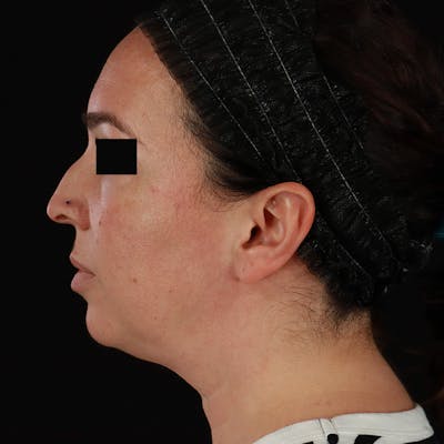 Neck Lift Before & After Gallery - Patient 413347 - Image 1