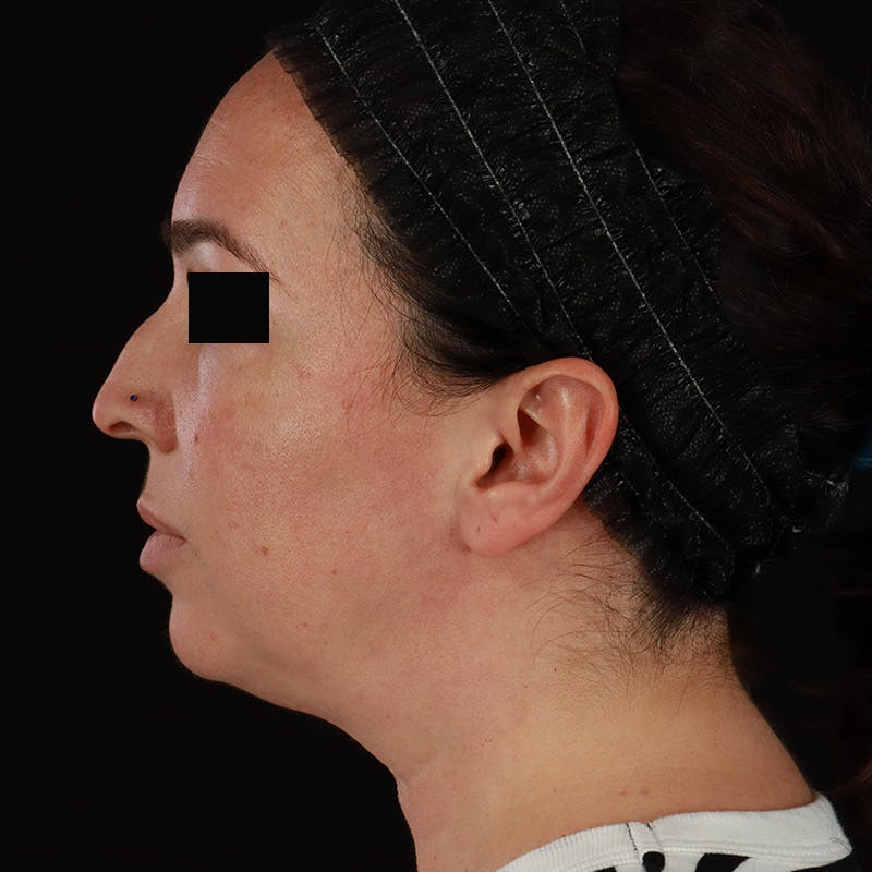 Neck Lift Before & After Gallery - Patient 413347 - Image 1