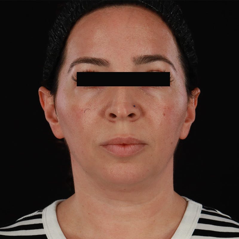 Neck Lift Before & After Gallery - Patient 413347 - Image 5