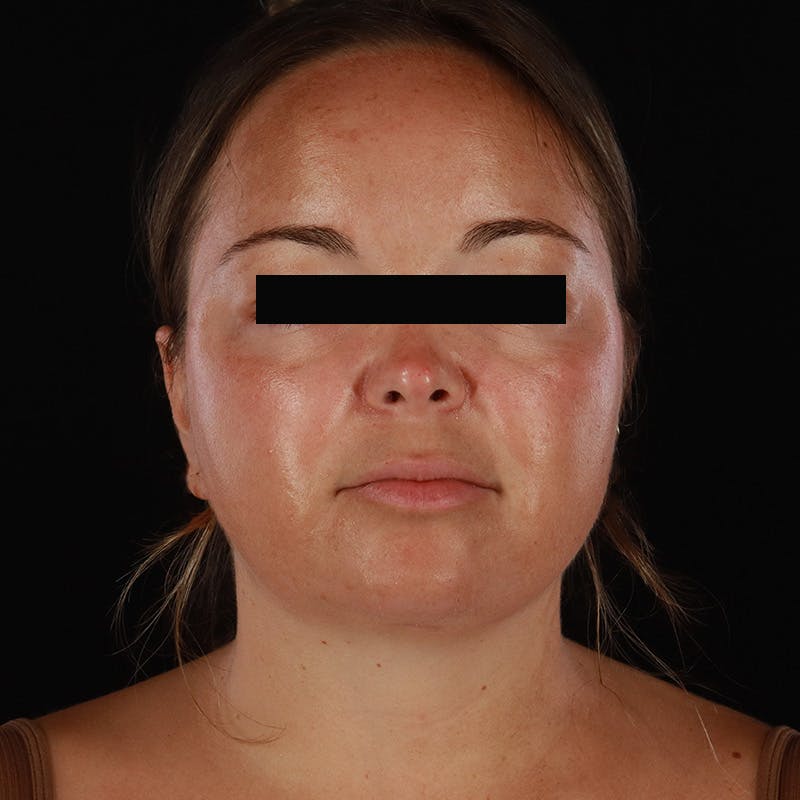 Neck Lift Before & After Gallery - Patient 294901 - Image 6