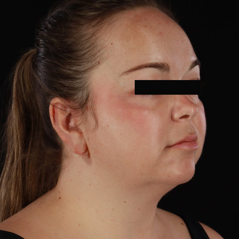 Neck Lift Before & After Gallery - Patient 294901 - Image 7
