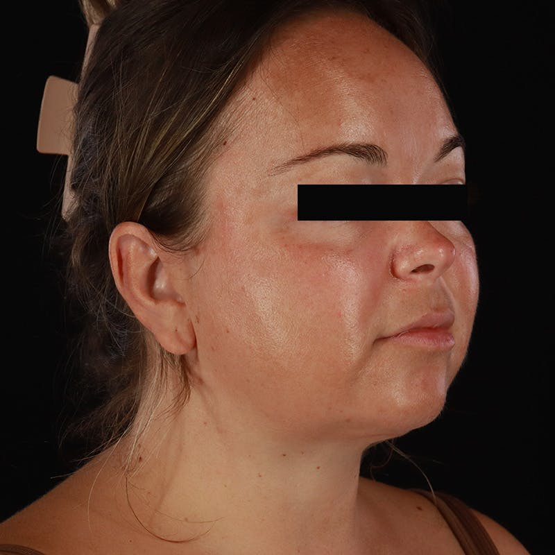 Neck Lift Before & After Gallery - Patient 294901 - Image 8