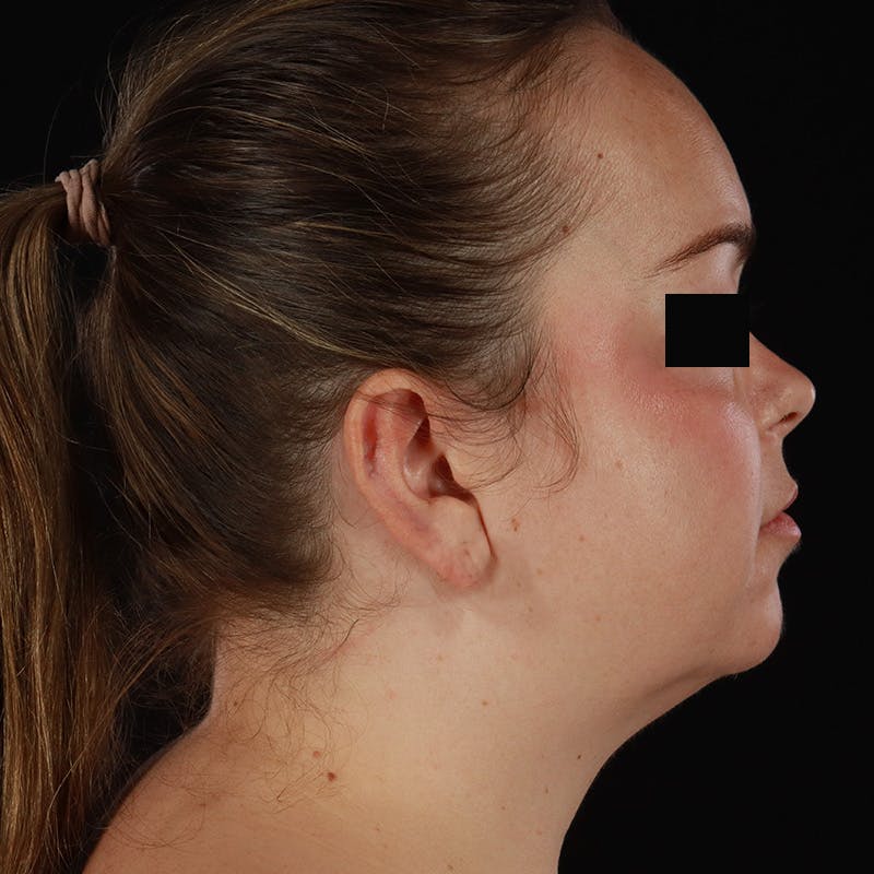 Neck Lift Before & After Gallery - Patient 294901 - Image 9