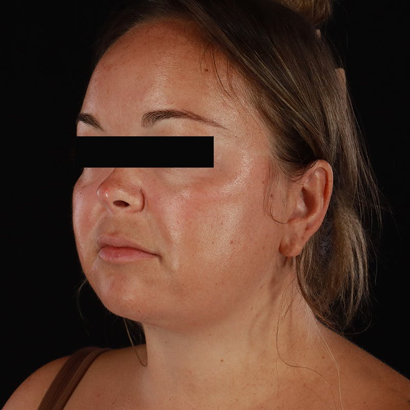 Neck Lift Before & After Gallery - Patient 294901 - Image 4