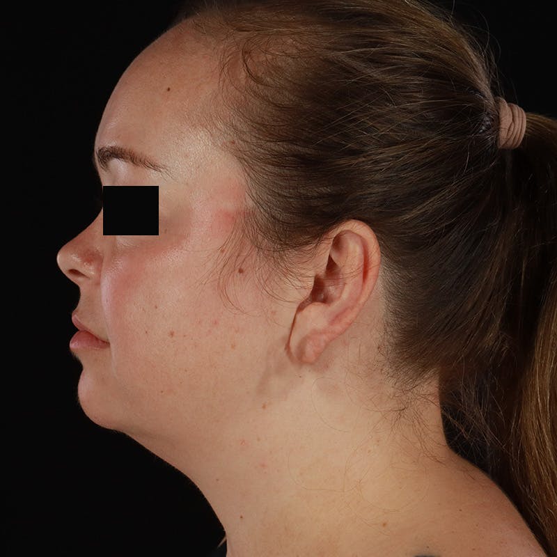 Neck Lift Before & After Gallery - Patient 294901 - Image 1