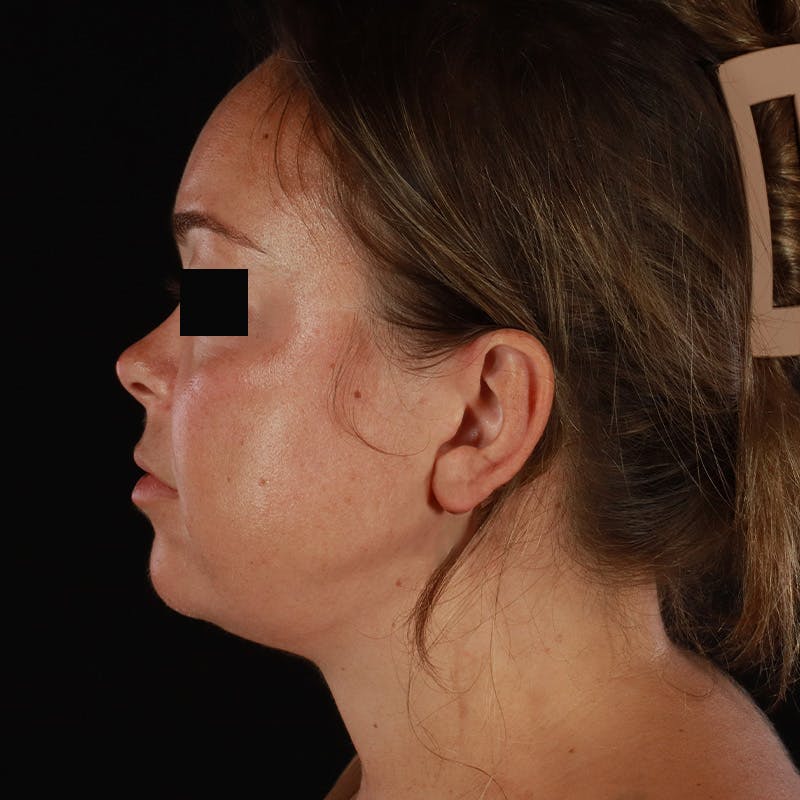 Neck Lift Before & After Gallery - Patient 294901 - Image 2