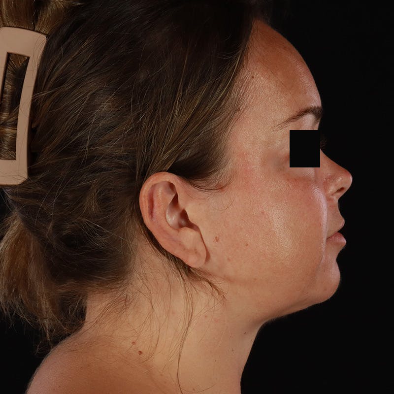Neck Lift Before & After Gallery - Patient 294901 - Image 10