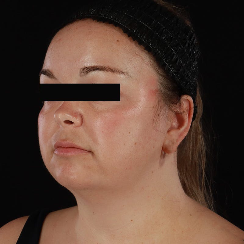 Neck Lift Before & After Gallery - Patient 294901 - Image 3